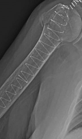 X-ray of bone