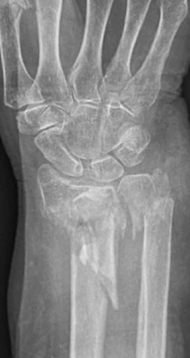 X-ray of bone