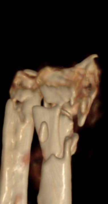 X-ray of bone