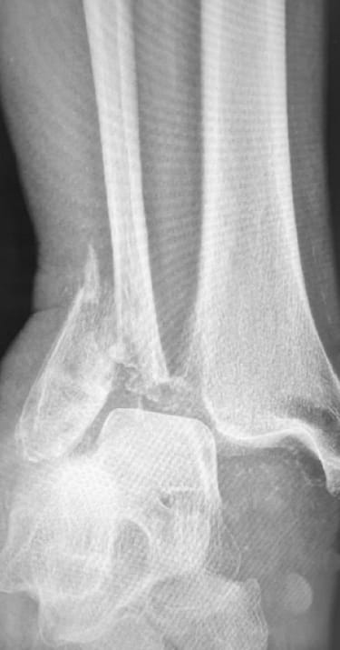 X-ray of bone