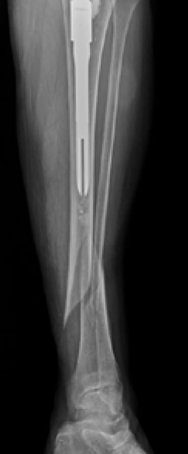 X-ray of bone