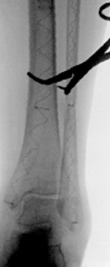 X-ray of bone