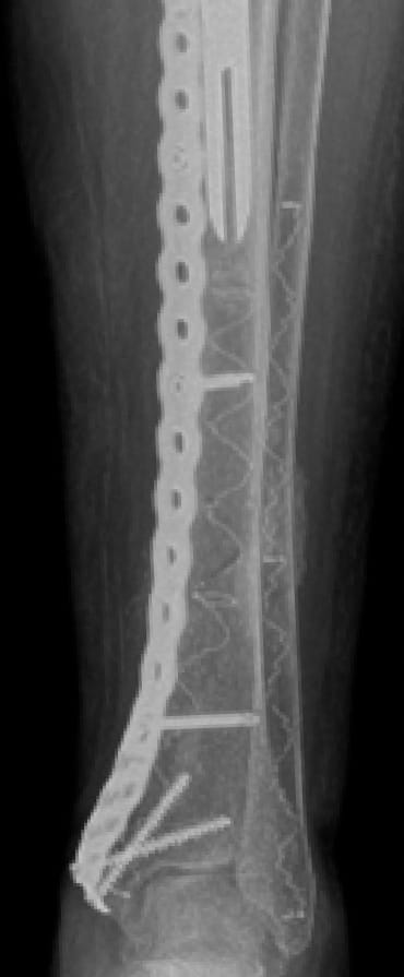 X-ray of bone