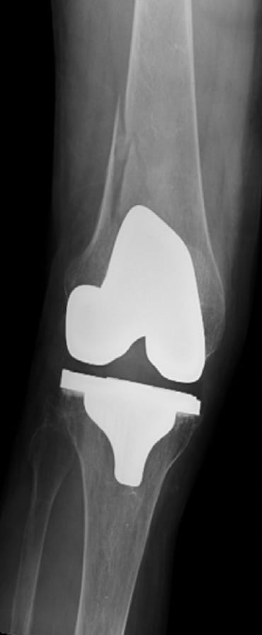 X-ray of bone