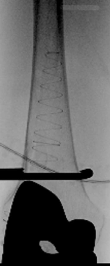 X-ray of bone
