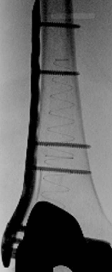 X-ray of bone