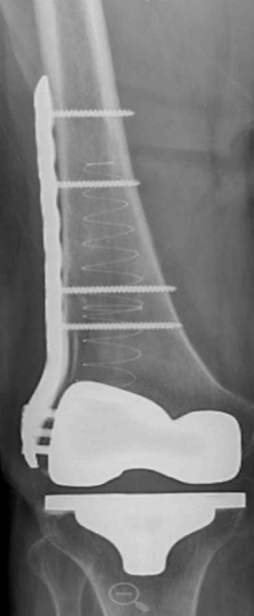 X-ray of bone