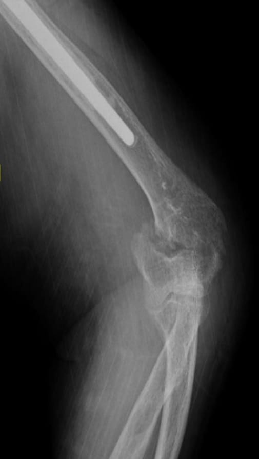 X-ray of bone