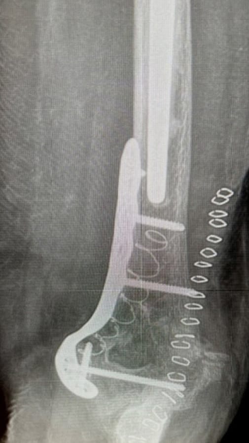 X-ray of bone