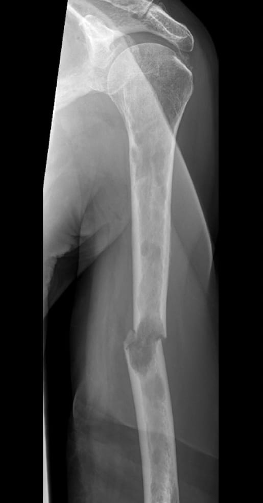 X-ray of bone