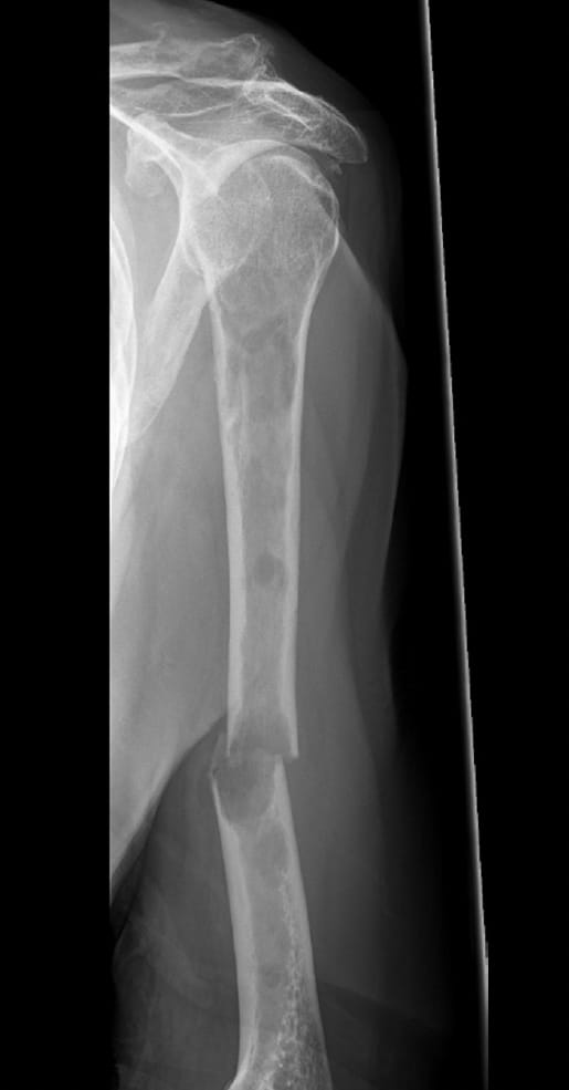 X-ray of bone