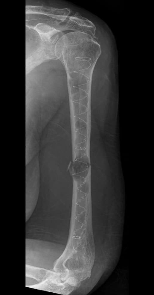 X-ray of bone