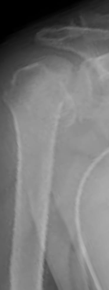 X-ray of bone