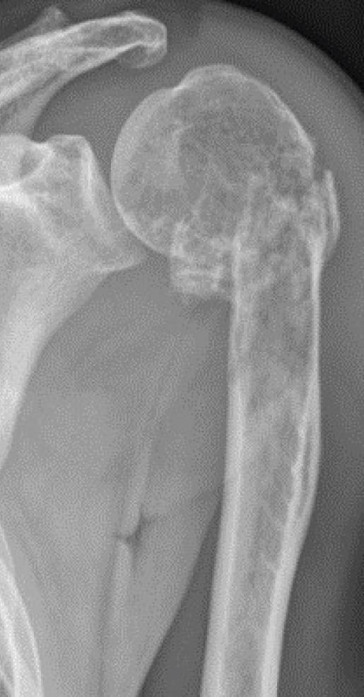 X-ray of bone