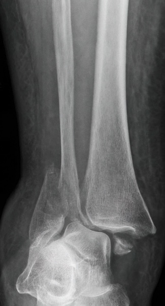 Trimalleolar Fracture