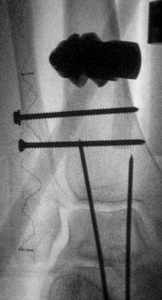 Fracture with implant x-ray